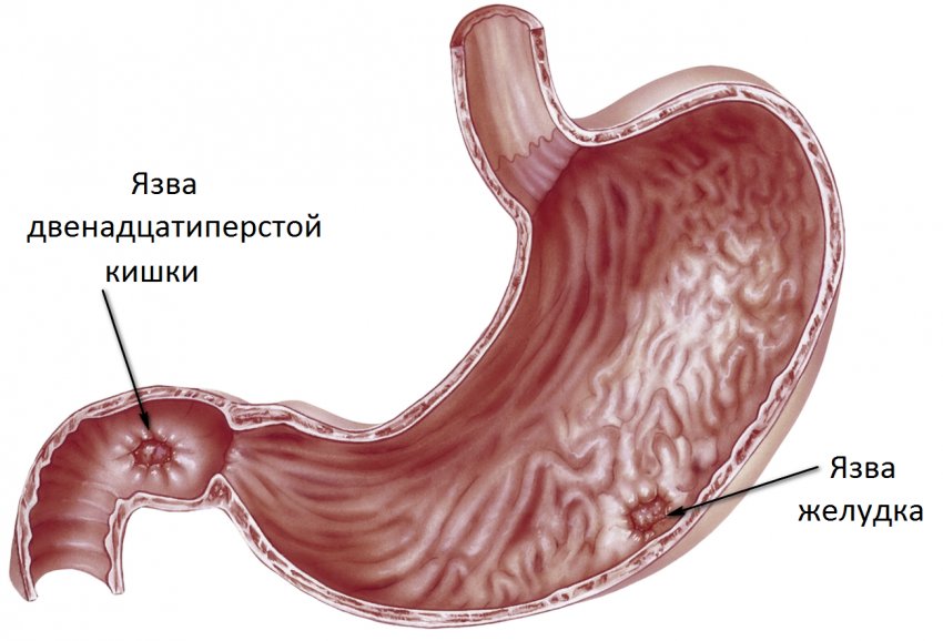 Язвенная болезнь желудка рисунок