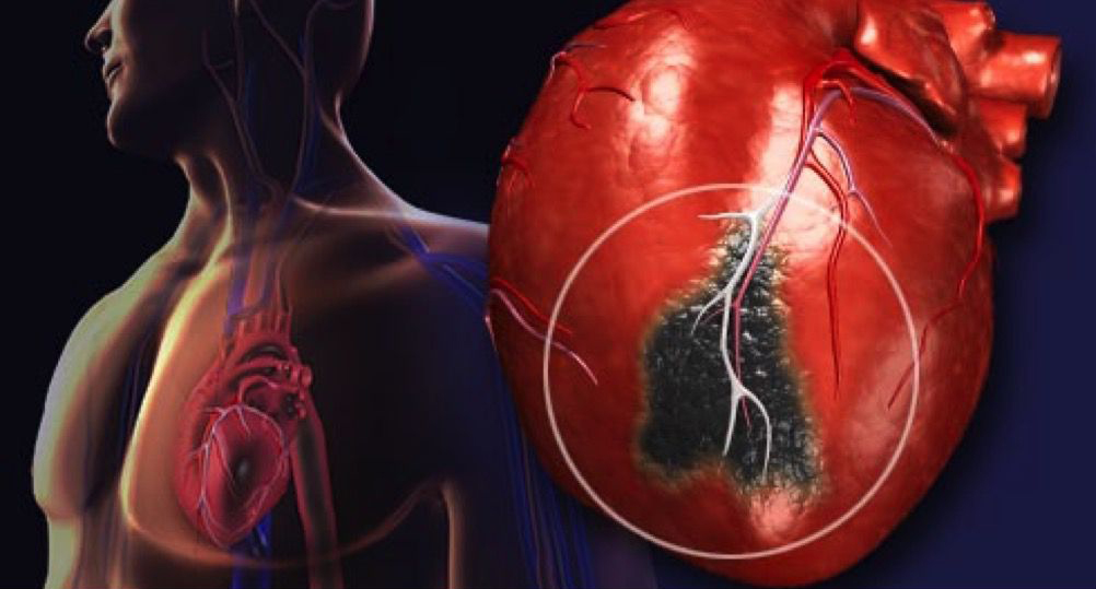 Необычный симптом инфаркта миокарда, который часто игнорируется